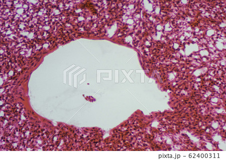 肺切片 顕微鏡写真 肺切片 顕微鏡写真 62400311