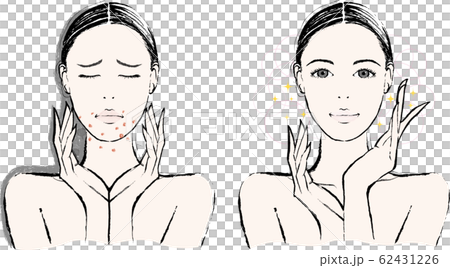 女性　大人ニキビ　ビフォーアフター 62431226