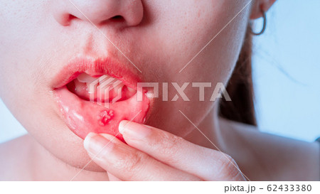 Asian women have aphthous ulcers on mouth on white 62433380