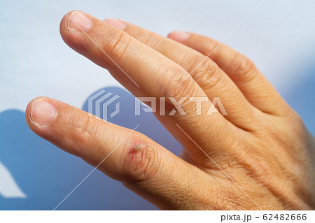 Woman peeled index finger and scar skin on hand, White background, Close up & Macro shot, Asian Body skin part, Healthcare concept 62482666