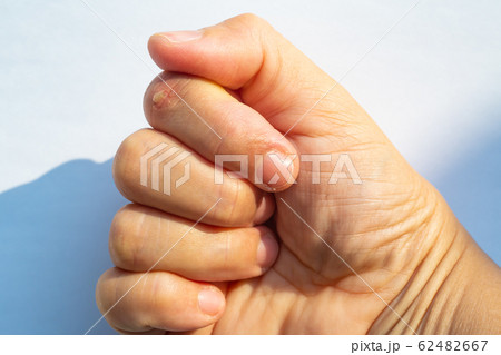 Woman peeled index finger and scar skin on hand, White background, Close up & Macro shot, Asian Body skin part, Healthcare concept Woman peeled index finger and scar skin on hand, White background, Close up & Macro shot, Asian Body skin part, Healthcare concept 62482667