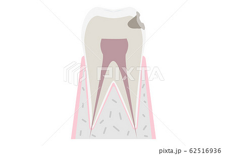 虫歯の進行、虫歯が象牙質に達する 62516936