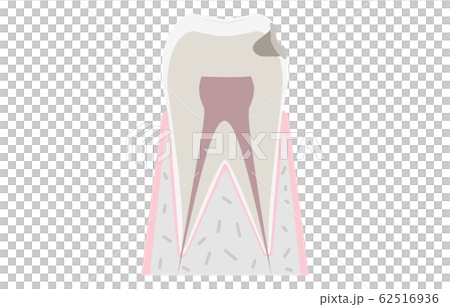 虫歯の進行、虫歯が象牙質に達する 62516936