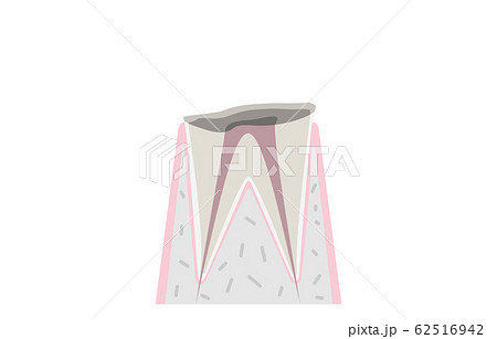 虫歯の進行、虫歯で歯の根だけが残る 虫歯の進行、虫歯で歯の根だけが残る 62516942