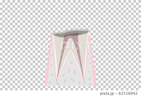 虫歯の進行、虫歯で歯の根だけが残る 虫歯の進行、虫歯で歯の根だけが残る 62516942