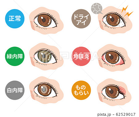 Eye Disease Eye Disease Stock Illustration