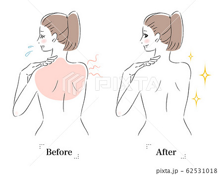 背中　肌　悩み　日焼け　ビフォーアフター　女性 62531018