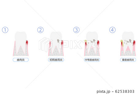 歯周病の進行イラスト、4段階 歯周病の進行イラスト、4段階 62538303