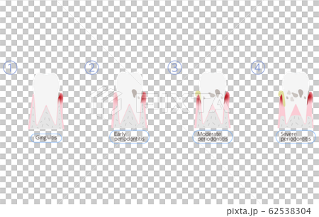 Periodontal disease progression illustration, 4 stages Periodontal disease progression illustration, 4 stages 62538304