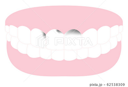 前歯に進行した虫歯のある歯のイラストのイラスト素材