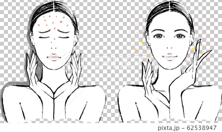 Female acne before and after 62538947