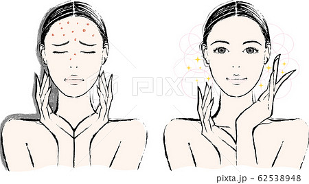 女性　ニキビ　ビフォーアフター 62538948