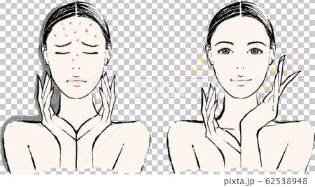 女性　ニキビ　ビフォーアフター 62538948