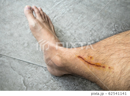 Man with long scab wound on his right leg Man with long scab wound on his right leg 62541141