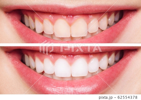 woman teeth before and after whitening. Over white background. Dental clinic patient. Image symbolizes oral care dentistry, stomatology woman teeth before and after whitening. Over white background. Dental clinic patient. Image symbolizes oral care dentistry, stomatology 62554378