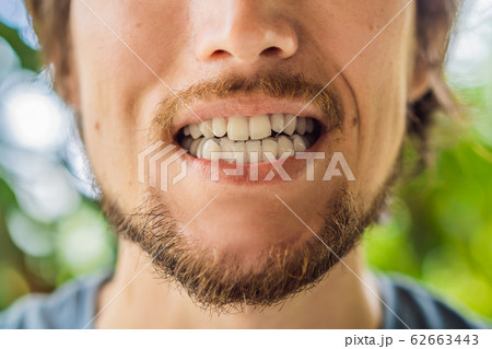 Man placing a bite plate in his mouth to protect his teeth at night from grinding caused by bruxism Man placing a bite plate in his mouth to protect his teeth at night from grinding caused by bruxism 62663443