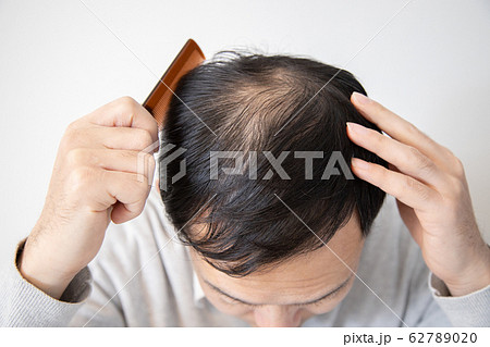 薄毛に悩む中年男性 薄毛に悩む中年男性 62789020