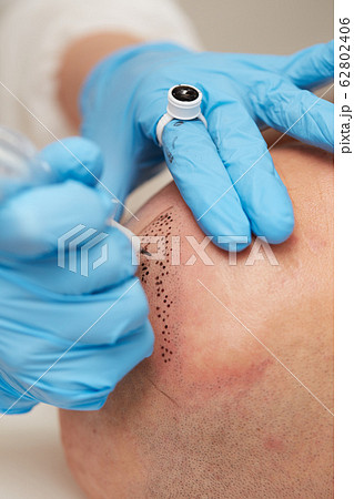 professional tattooist making permanent make up tricopigmentation 62802406