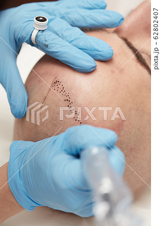 professional tattooist making permanent make up tricopigmentation 62802407