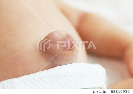 赤ちゃんのでべそ 赤ちゃんのでべそ 62816950