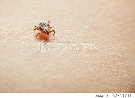 Tick on skin Tick on skin 62851743