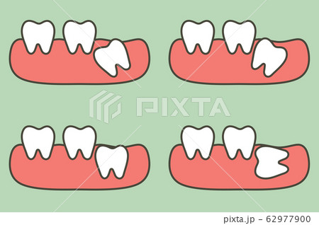 type of wisdom tooth affect to other teeth type of wisdom tooth affect to other teeth 62977900