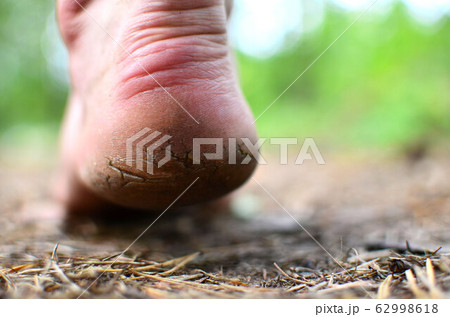 Men's foot with rough skin and a dry heel with many cracks 62998618