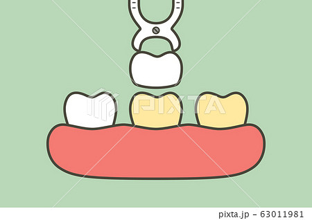dental veneers installation procedure for tooth whiten 63011981