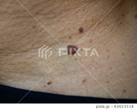 Brown moles on woman's neck, Medicine, Close up & Macro shot, Selective focus, Asian Body skin part, Healthcare concept Brown moles on woman's neck, Medicine, Close up & Macro shot, Selective focus, Asian Body skin part, Healthcare concept 63023518