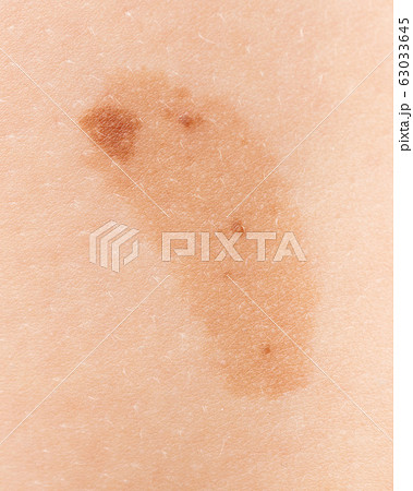 Birthmark on the skin of a person 63033645