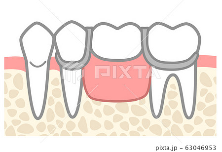 部分入れ歯 図解 ワイヤーしっかり目 歯の色なしのイラスト素材