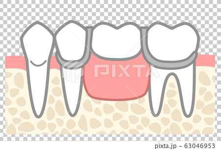 部分入れ歯 図解 ワイヤーしっかり目 歯の色なしのイラスト素材 63046953 Pixta