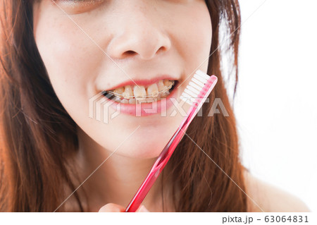 歯列矯正をする若い女性 63064831