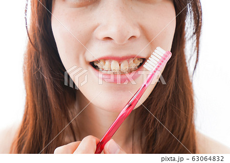 歯列矯正をする若い女性 63064832