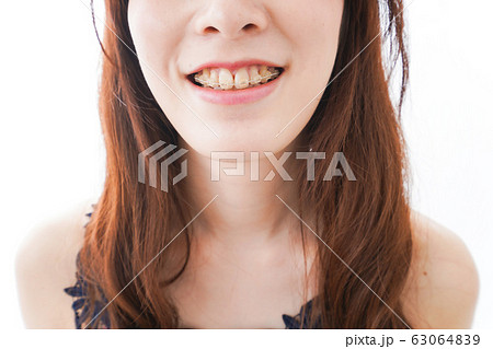 歯列矯正をする若い女性 63064839