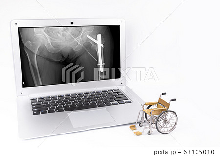 大腿骨骨折　レントゲン画像　車椅子 63105010