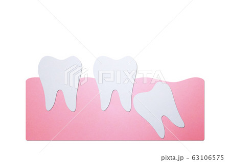 wisdom tooth ( angular or mesial impaction ) affect to other teeth 63106575
