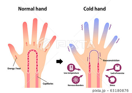 通常の手と末端冷え性の手 比較イラスト (冷え性の原因) / 英語 63180876