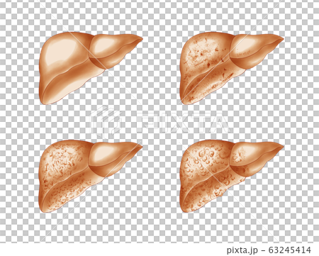 Liver disease progression 63245414