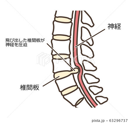 背骨　図解　椎間板ヘルニア　文字あり　アップ 63296737