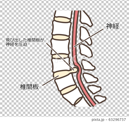 背骨　図解　椎間板ヘルニア　文字あり　アップ 63296737