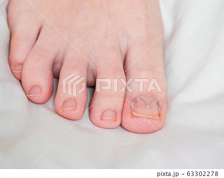 Toenail clamp is mounted on an ingrown toenail 63302278