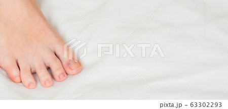 Toenail clamp is mounted on an ingrown toenail Toenail clamp is mounted on an ingrown toenail 63302293