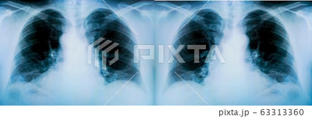Set of X-ray of a patient's lungs with pronounced traces of the inflammatory process 63313360