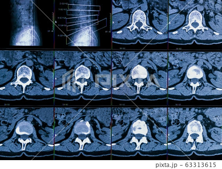 Results of computer tomography or CT imaging of human spine of a patient with chronic back pain, shows degenerative changes of spines, lumbar discs herniation and nerve roots compression Results of computer tomography or CT imaging of human spine of a patient with chronic back pain, shows degenerative changes of spines, lumbar discs herniation and nerve roots compression 63313615