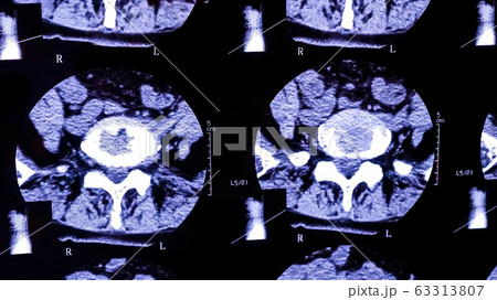 Results of magnetic resonance imaging of a patient spine with chronic back pain. The MRI shows degenerative changes of spines, lumbar discs herniation and nerve roots compression. Results of magnetic resonance imaging of a patient spine with chronic back pain. The MRI shows degenerative changes of spines, lumbar discs herniation and nerve roots compression. 63313807