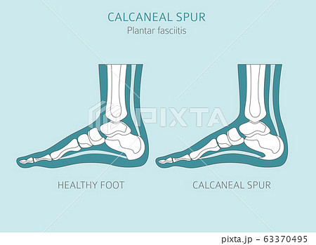 Calcaneal spur. Plantar fasciitis set. Medical 63370495