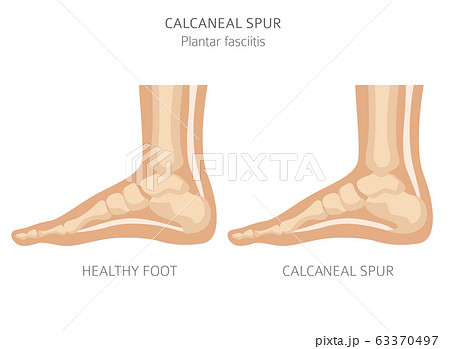 Calcaneal spur. Plantar fasciitis set. Medical 63370497