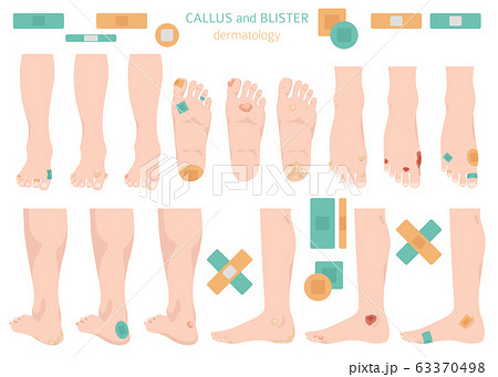 Callus, corn and blister feet and hands. 63370498