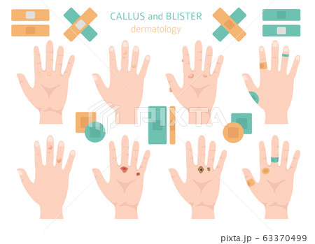 Callus, corn and blister feet and hands. 63370499